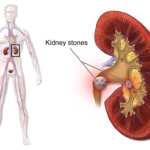 pass kidney stones fast