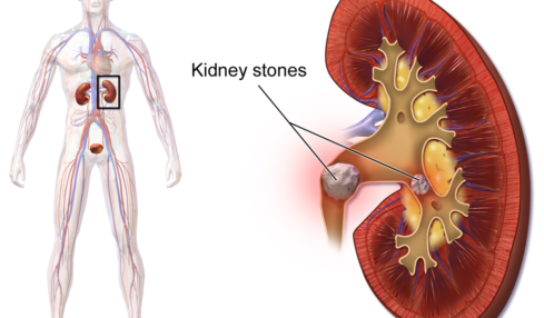 pass kidney stones fast