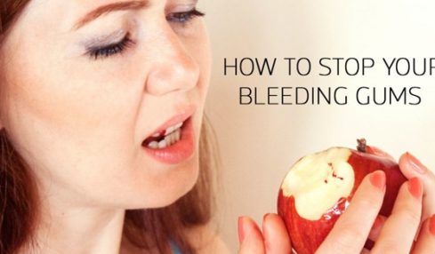 Bleeding Gums